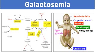 Galactosemia And Galactose Metabolism  Galactosemia Biochemistry [upl. by Jonette]