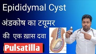 Epididymal cyst homeopathic medicine Pulsatilla for Epididymal cyst in hindi [upl. by Critchfield]