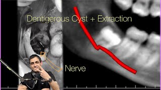 Dentigerous Cyst and Lower Wisdom Tooth with Four Roots Watch my podcast DrWahanExperiment [upl. by Nirehtac]