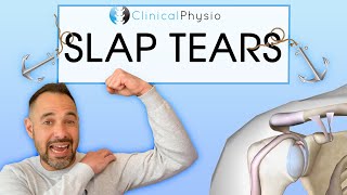 Superior Labral Anterior Posterior Tears  Everything you need to know about SLAP tears [upl. by Mann]