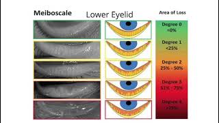 Eyedeology Eye School What is Meibomian Gland Dysfunction MGD [upl. by Auqinet]