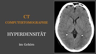 Computertomographie I Hyperdensität im Gehirn I Neuroradiologie I Brain amp Synapse [upl. by Enoid]