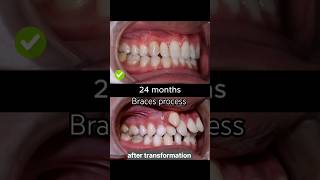 braces are very crooked braces process braces orthodontist dentist dental shorts viral [upl. by Nwahsad]