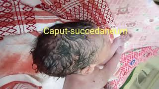 🥰👉Caput succedaneum [upl. by Ailegna]