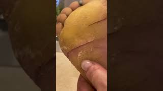 Fissure crack maintenance  Keratoderma Callus EPPK Hyperkeratosis  May 8 2023 [upl. by Larine]