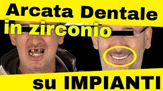 Arcata dentale su impianti con lo zirconio [upl. by Eeral]