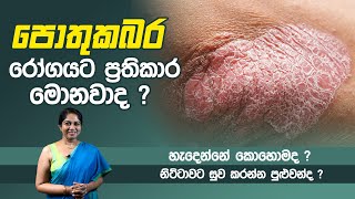 Psoriasis පොතුකබර Treatment in Sri Lanka  Dr Nayani Madarasinghe [upl. by Arremat760]