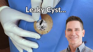 Gooey Oozy Cyst  CONTOUR DERMATOLOGY [upl. by Schreck254]