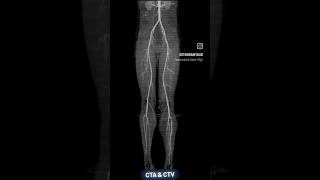 CT Angiography and CT Venography angiography cardiology cardiologist angioplasty heartmedicine [upl. by Daniell165]