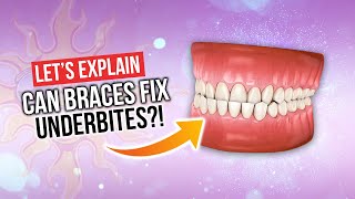 Can Braces Fix UNDERBITES [upl. by Zerla]