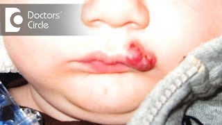 What is Hemangioma of skin  Dr Sachith Abraham [upl. by Reyem]