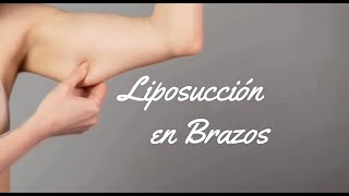 Preguntas frecuentes sobre liposuccion en brazos  Braquioplastia  Dra Claudia Nieto González [upl. by Erick939]