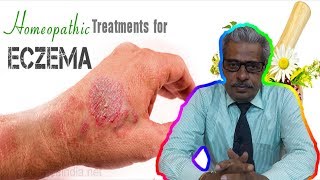 Eczema Dermatitis Treatment in Homeopathy by Dr PS Tiwari [upl. by Nhepets]