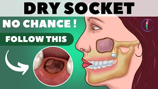 Tooth extraction aftercare I Wisdom tooth extraction  Tips for faster healing amp prevent dry socket [upl. by Berne278]