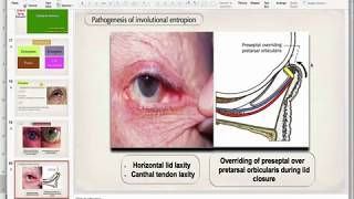 Entropion [upl. by Shaw]
