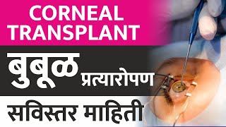 What is Corneal Transplant  जाणून घ्या बुबूळ प्रत्यारोपण विषयी सविस्तर माहिती [upl. by Ark]