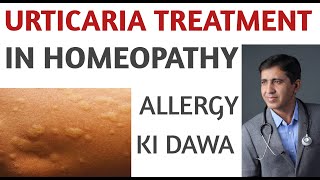 Urticaria  Pitti  एलर्जी की दवा  Urticaria Homeopathic Treatment Medicine In Hindi  Paras Homeo [upl. by Airetahs324]