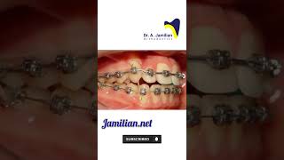 How Orthodontics Straighten teeth Braces Aligners orthodontics orthodontist dentistbonding [upl. by Nailuj]