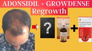 Hair Regrowth Results of Adonsidil x Growdense जान आप चौक जायेगे  Hair fall solution [upl. by Hgielrac665]