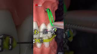 ¡Instalación de microimplante dental en el hueso [upl. by Iknarf]