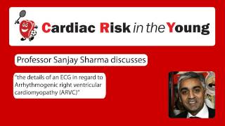 ECG 7 Arrhythmogenic right ventricular cardiomyopathy ARVC [upl. by Assed]