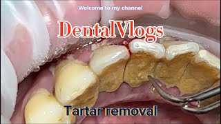 Tartar removal  Dentist [upl. by Hatokad]