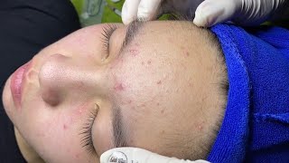 The best acne squeezing collection form Linh Mun Spa part 11 [upl. by Per659]