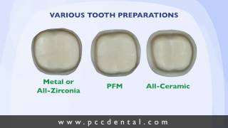 Ask Gordon Crown tooth preparation technique [upl. by Soren]