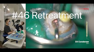 46  Retreatment of Mandibular Molar with Microscope 33 [upl. by Eustasius939]