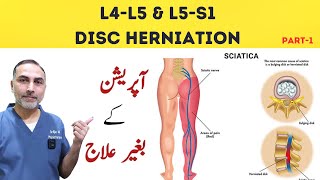 L4  L5 and L5 S1 Disc Herniation Treatment  Slip Disc Treatment At Home sciatica [upl. by Truc]