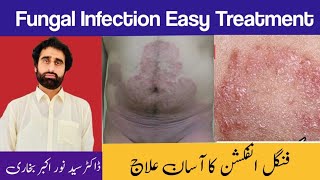 RINGWORM TREATMENTFUNGUS KA Ilaj  Daad Ko Jad Se Kaise Khatam Kare  दाद का इलाज [upl. by Lynnette]