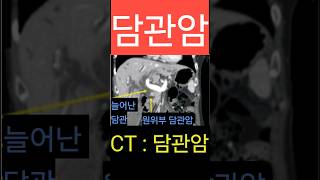 담관암 담도암 CT 진단 담관 담도 [upl. by Zeta]