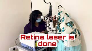 How is RETINA LASER done lasereyesurgery retinalaser [upl. by Eniamirt]