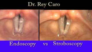 Video Stroboscopy of the Vocal Cords Dr Rey Caro [upl. by Neesay530]