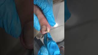 Fix Curved Ingrown Toenails With One Easy Move【Nail Warrior】 [upl. by Herzberg]