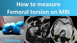 How to Measure Femoral Torsion on MRI [upl. by Devi]