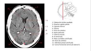 Encéfalo por imagens de tomografia [upl. by Darin]