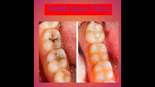 teeth laser fillingteeth filling [upl. by Krasnoff]