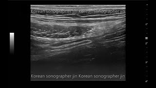 Practice5 Look for appendix  실습5 appendix 찾기 ultrasound sonography [upl. by Aekal996]