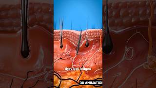 How Splinters Get Unstuck 3D ANIMATION [upl. by Ronal]