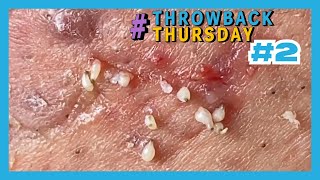 TBT 2 PIMPLE POPPING [upl. by Ais354]