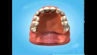 Acrylic amp Chrome Dentures [upl. by Gianina]