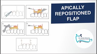 APICALLY REPOSITIONED FLAP PERIODONTAL FLAP SURGICAL TECHNIQUE DR ANKITA KOTECHA [upl. by Aseela610]