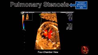 Fetal Echocardiography Pulmonary Stenosis [upl. by Adnohsed]