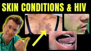 Doctor explains skin conditions associated with HIV  AIDS eg Kaposi sarcoma candida amp more [upl. by Fleta]