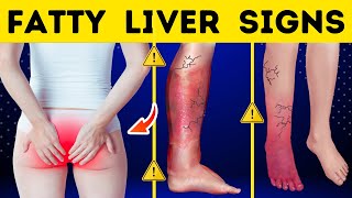 8 WARNING Signs You Have A FATTY LIVER  Fatty Liver Warning Signs [upl. by Atterbury]