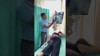 Most challenging scoliosis case treatment by DrRavi scoliosis chiropractic spine shorts reels [upl. by Arihk]