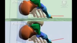 Comparison of Normal Gait to Equinus Gait [upl. by Strain]