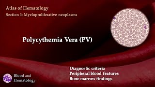 Polycythemia vera PV [upl. by Eetsirk687]