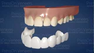 How Press On Veneers Cover Teeth [upl. by Nylkaj]